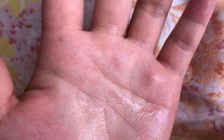 玩游戏手出汗怎么办？是病吗，有什么解决妙招